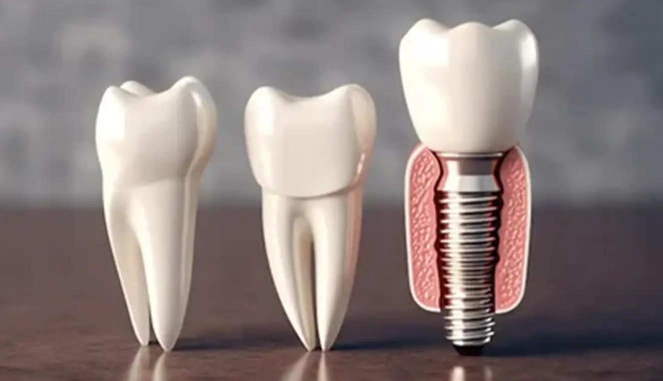 Home 42 Upper Jaw Dental Implants