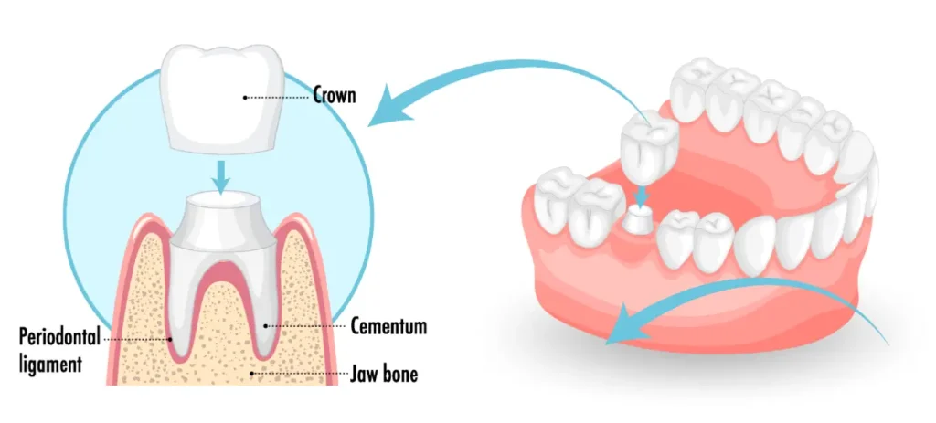 Zirconium Crowns