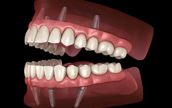 All-on-4 Dental Implants