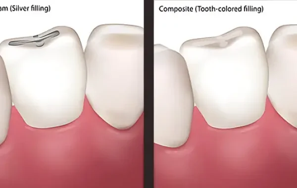 Composite Bonding
