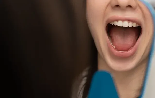 Dental Veneers - OGN Dental Studio Antalya, Turkey