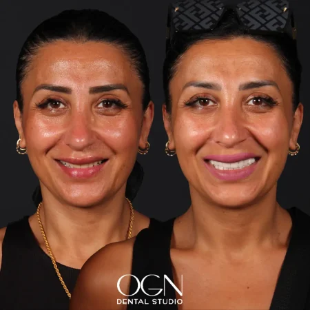 Before & After - OGN Dental - Antalya, Turkey