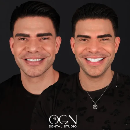 Before & After - OGN Dental - Antalya, Turkey