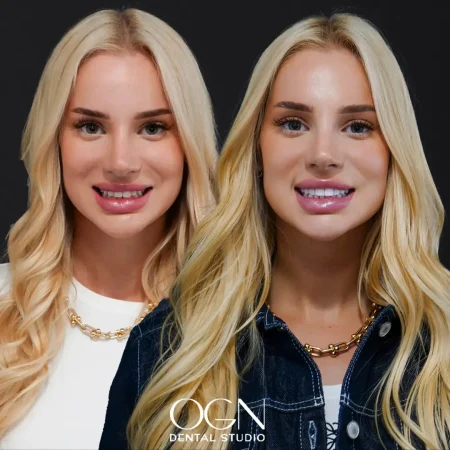Before & After - OGN Dental - Antalya, Turkey